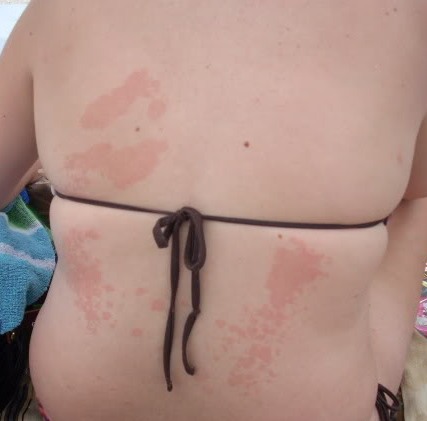 This image has an empty alt attribute; its file name is tinea-versicolor-1.jpg